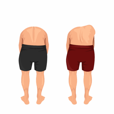 Adam’s Forward Bend Test