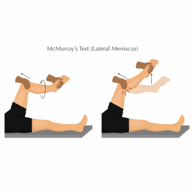 McMurray's Test - Lateral Meniscus