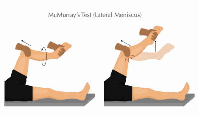 McMurray's Test - Lateral Meniscus