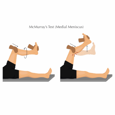 McMurray's Test - Medial tMeniscus