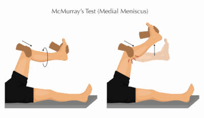 McMurray's Test - Medial Meniscus